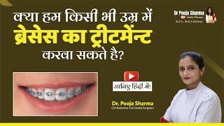 Can We Get Braces Treatment At An Adult Age? | Age For Braces | Best Braces Treatment In Agra, UP