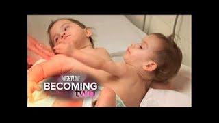 Conjoined Twins, Erika & Eva Sandoval Successfully Separated