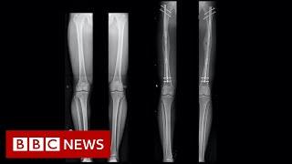 Leg-lengthening: The people having surgery to be a bit taller - BBC News