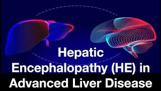 Hepatic Encephalopathy (HE) in Advanced Liver Disease