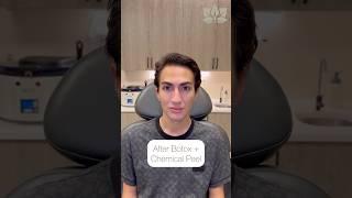 Before + After: Botox with Chemical Peel