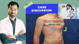 Pectus Carinatum (Keel Chest): Causes, Symptoms, and Treatment Explained