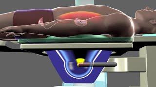 Shockwave Lithotripsy