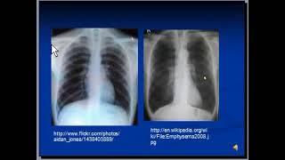 Chest Xray : COPD & Emphysema ( by hammadshams)