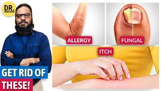 Get Rid of Itchy Skin, Skin Allergy & Fungal Infection! (Urdu/Hindi) Kharish | Dr. Ibrahim