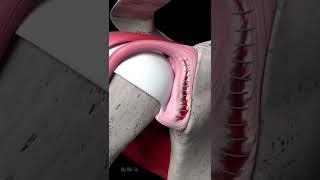 Shoulder Labrum Tear Repair (Animation)