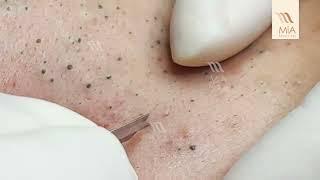 SUPER BLACKHEADS at MiA Beauty Spa