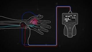 Train of Four Monitoring using the Ulnar Nerve