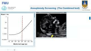 Pre-eclampsia and Aneuploidy Screening Updated