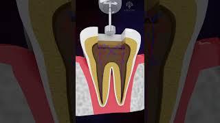 Explained Root Canal Treatment in 40 Seconds  | RCT | #shorts #facts  - Creativelearning3d