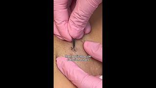 Ingrown hair extraction