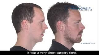 Jaw surgery Case # 104: Johan - Sleep apnea, maxillo-mandibular retrusion