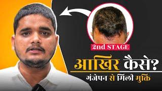 "मैं गंजेपन के 2nd Stage में था लेकिन फिर..." | Dr. A Khan Review | Hairloss Treatment