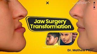 Jaw Surgery Amazing Transformation | Fast Recovery Time