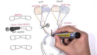 Visual Pathway and Lesions