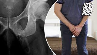 X-rays reveal ‘calcified’ penis that doctors say is turning to bone