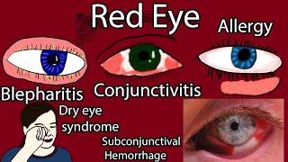 Red Eye Causes, Symptoms and Treatment. Pink eye causes