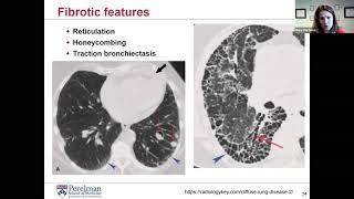 Interstitial Lung Disease for the General Internist