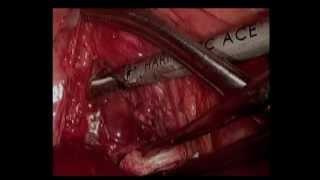 Thoracoscopic Resection of Giant Mediastinal Parathyroid Tumor