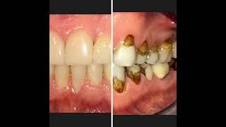 Before and After:  Full Mouth Rehabilitation Success