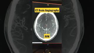 CT Brain Angiography Diagnosing AVM #shorts #trending #viral #radiology