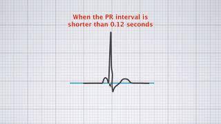 Interpreting ECG duration