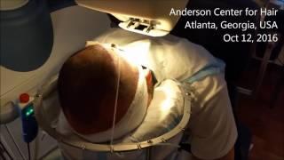 Anderson Center for Hair - latest upgrades to our ARTAS Robotic Hair Transplant system