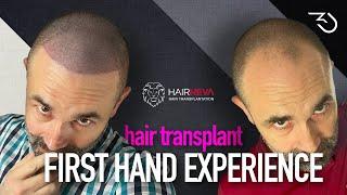 Best Hair Transplant Turkey Package: My DHI experience with HairNeva