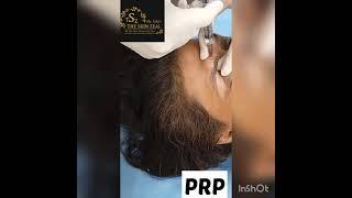 PRP Therapy In Zirakpur | 72-93-93-93-26 | The Skin Zeal