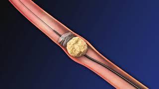 CoAx 10mm Stone Control Catheter from Accordion Medical