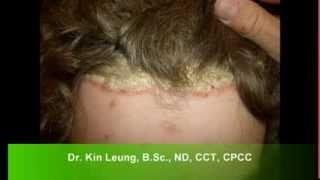 Dr Kin Leung Naturopathic Case Review Patient with Psoriasis Vulgaris plaque silver scales on scalp