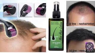 Great Hair growth formula Really works Derma roller with Neo hair lotion Use Daily