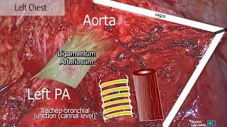 VATS Biopsy of Left 4L Nodes From a Right Approach