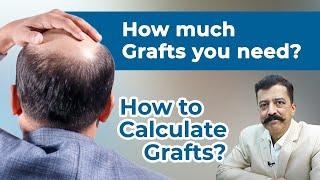 How Much Grafts You Need For Hair Transplant | How to Calculate Grafts Required for Hair Transplant