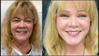 Real Transformation: Lower Face, Neck Lift & Upper Eyelid Surgery under local anesthesia