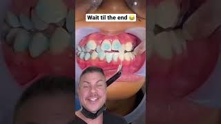 How Braces Are Put On