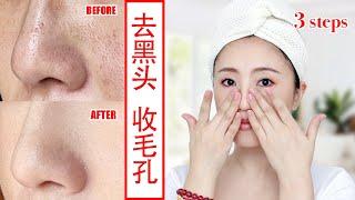 Easy 3 Steps, Remove Blackheads and Whiteheads Natural at home quickly