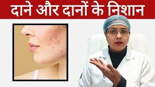 How to Treat Acne | Acne Spots kaise thik karen | all about acne #skin #acne #spots