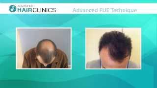 FUE results by Dr. Anastasios Vekris (video)