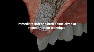 Immediate tissue augmentation technique with application of cerabone® and Jason® membrane