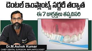 డెంటల్ ఇంప్లాంట్స్ తర్వాత | 7 Tips to Maintaining Your Dental Implants | Teeth Care Tips In Telugu