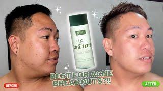 TONER FOR ACNE BREAKOUTS?! 100 PESOS  LANG AND EFFECTIVE!! ( XBC Tea Tree Facial Toner)