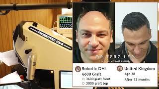 Robotic DHI Hair Transplant and Before - After Photos