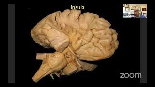  Microsurgical Resection of Insular Gliomas