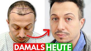 Nur 7 Monate nach der Haartransplantation in Deutschland | Erfahrung