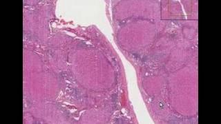 Histopathology Liver--Cirrhosis