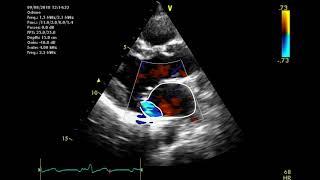 Echocardiographic assessment of the mitral valve