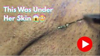 Most-Watched Ingrown Extractions | #throwback  | Epi 3