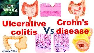 Ulcerative colitis Vs Crohn's disease  #inflammatoryboweldisease