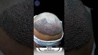 From planning to perfection! Watch the journey of rediscovering confidence through a hair transplant